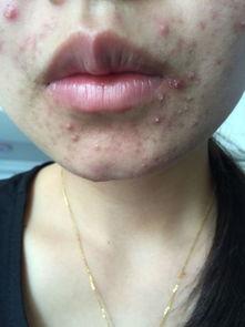 为什么吃瓜长痘痘,吃瓜为何诱发痘痘之谜